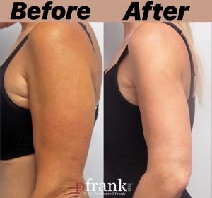 Tumescent Laser Lipo Before and After photo by Dr. Paul Jarrod Frank of PFRANKMD in New York City, NY