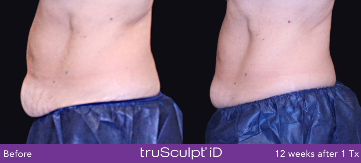TruSculptiD Before and After photo by Dr. Paul Jarrod Frank of PFRANKMD in New York City, NY