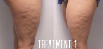 BIOSTIM Treatments Before and After Photo by Dr. Frank in New York, NY