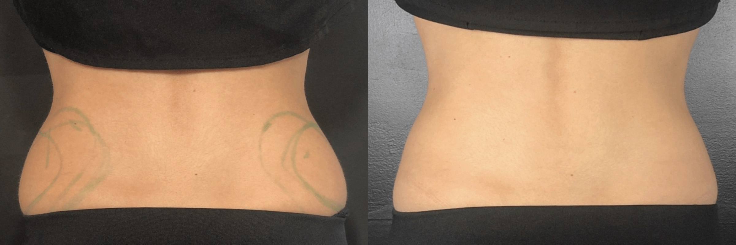 CoolSculpting Before and After Photo by Dr. Frank in New York, NY