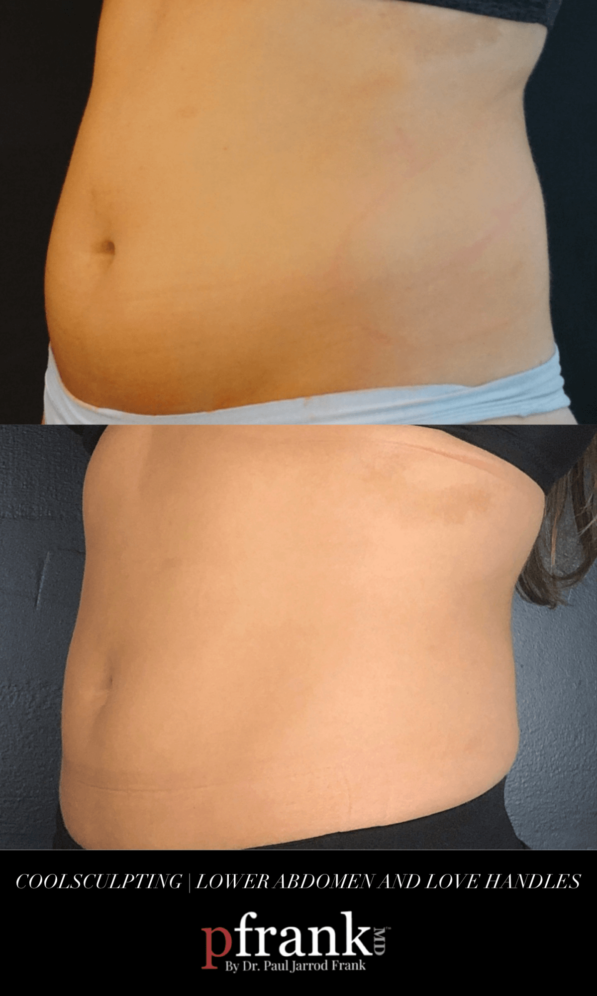Coolsculpting Before and After photo by Dr. Paul Jarrod Frank of PFRANKMD in New York City, NY