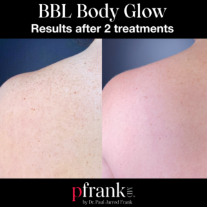 BBL Body Glow before and after photo by Dr. Paul Jarrod Frank of PFRANKMD in New York City, NY