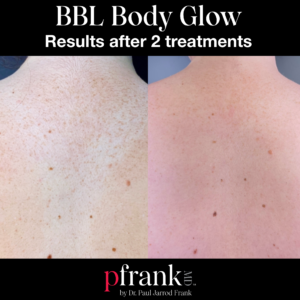 BBL Body Glow Before and After photo by Dr. Paul Jarrod Frank of PFRANKMD in New York City, NY