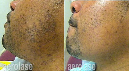 NeoElite Laser Before and After Photo by Dr. Frank in New York, NY
