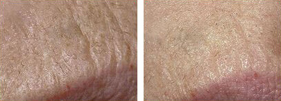 Medlite Laser Toning Before and After photo by Dr. Paul Jarrod Frank of PFRANKMD in New York City, NY