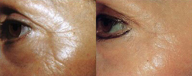 Medlite Laser Toning Before and After Photo by Dr. Frank in New York, NY
