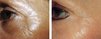 Medlite Laser Toning Before and After photo by Dr. Paul Jarrod Frank of PFRANKMD in New York City, NY