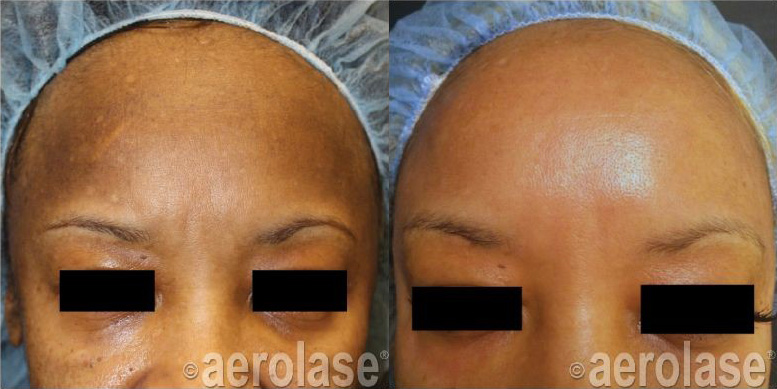 NeoElite Laser Before and After Photo by Dr. Frank in New York, NY