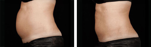 SculpSure Before and After photo by Dr. Paul Jarrod Frank of PFRANKMD in New York City, NY