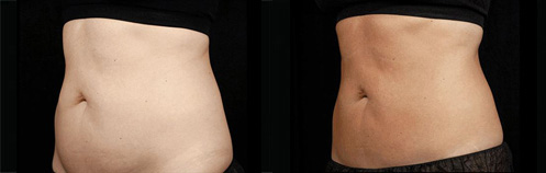 Sculpsure Before and After Photo by Dr. Frank in New York, NY