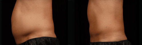 Sculpsure Before and After Photo by Dr. Frank in New York, NY