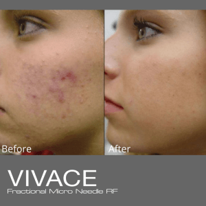 Vivace Microneedling RF before and after photo by Dr. Paul Jarrod Frank of PFRANKMD in New York City, NY