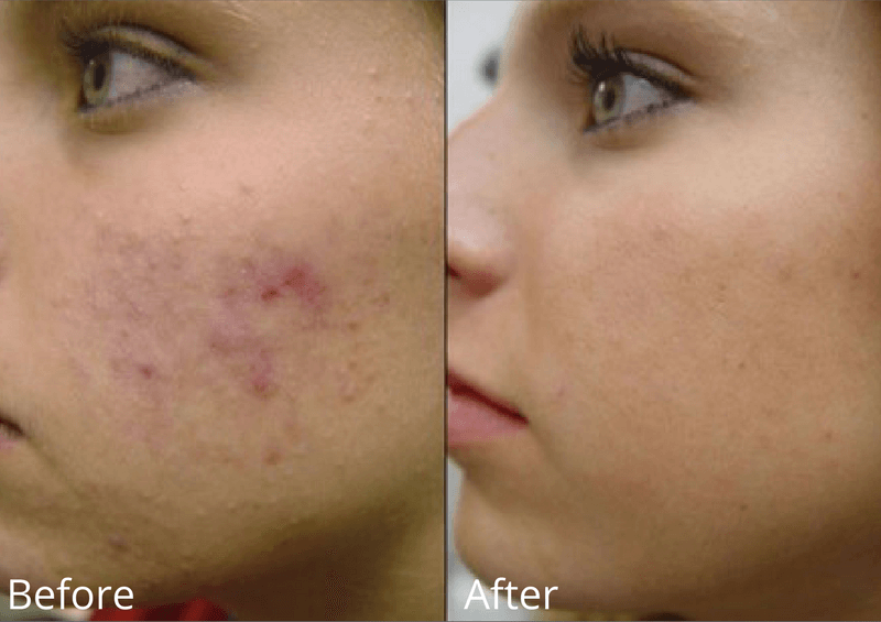Vivace Microneedling Before and After Photo by Dr. Frank in New York, NY