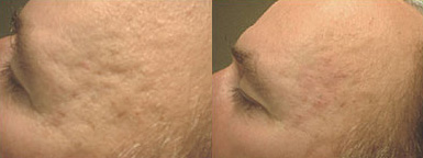 Acne Scars Before and After Photo by Dr. Frank in New York, NY