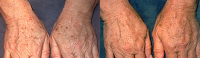 Age Spots Before and After Photo by Dr. Frank in New York, NY