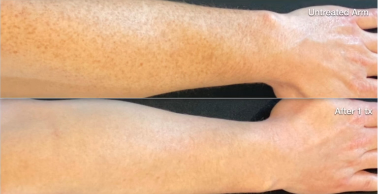 BBL Body Glow Before and After Photo by Dr. Frank in New York, NY
