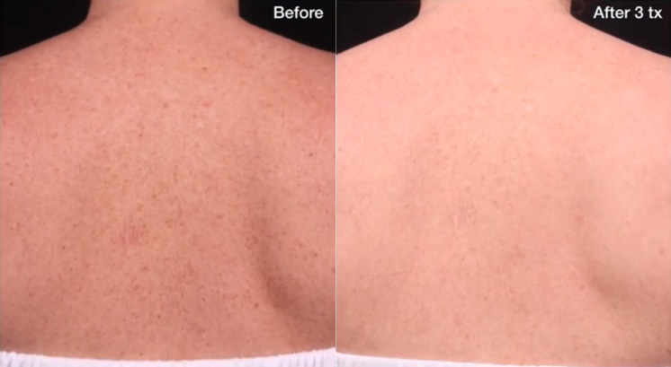 BBL Body Glow Before and After Photo by Dr. Frank in New York, NY