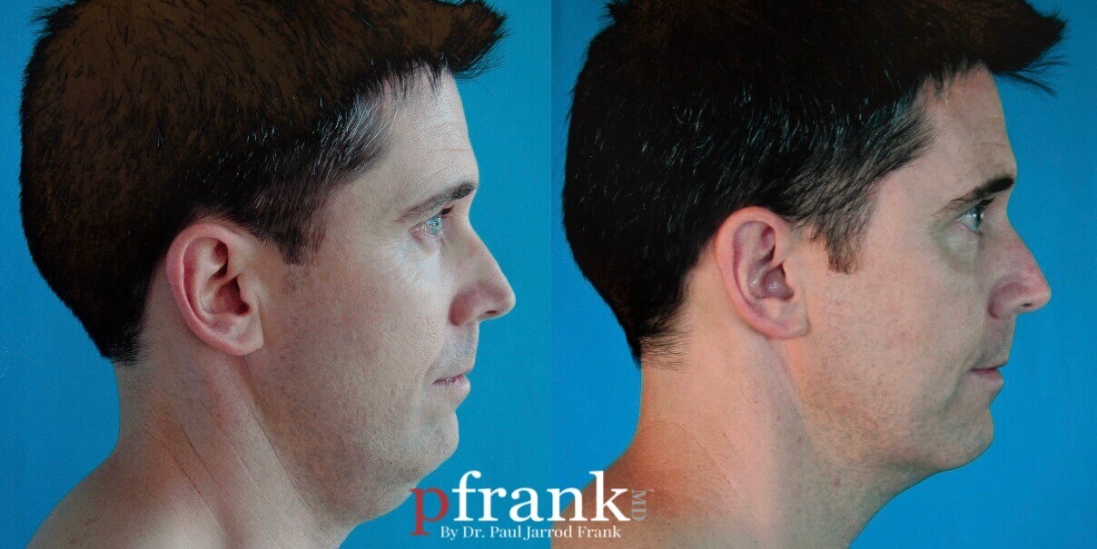 UltraTight™ Before and After photo by Dr. Paul Jarrod Frank of PFRANKMD in New York City, NY