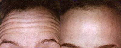 Botox Before and After Photo by Dr. Frank in New York, NY