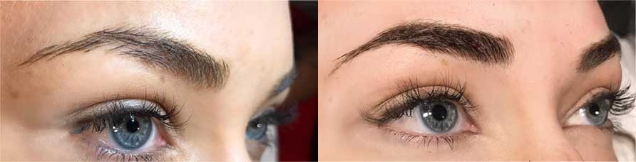 BROW2 Eyebrow Embroidery Before and After Photo by Dr. Frank in New York, NY