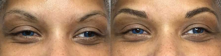 BROW2 Eyebrow Embroidery Before and After Photo by Dr. Frank in New York, NY
