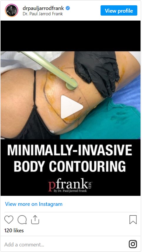 BodyTite body contouring by Dr. Paul Jarrod Frank of PFRANKMD in New York City, NY