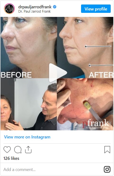 FaceTite treatment by Dr. Paul Jarrod Frank of PFRANKMD in New York City, NY