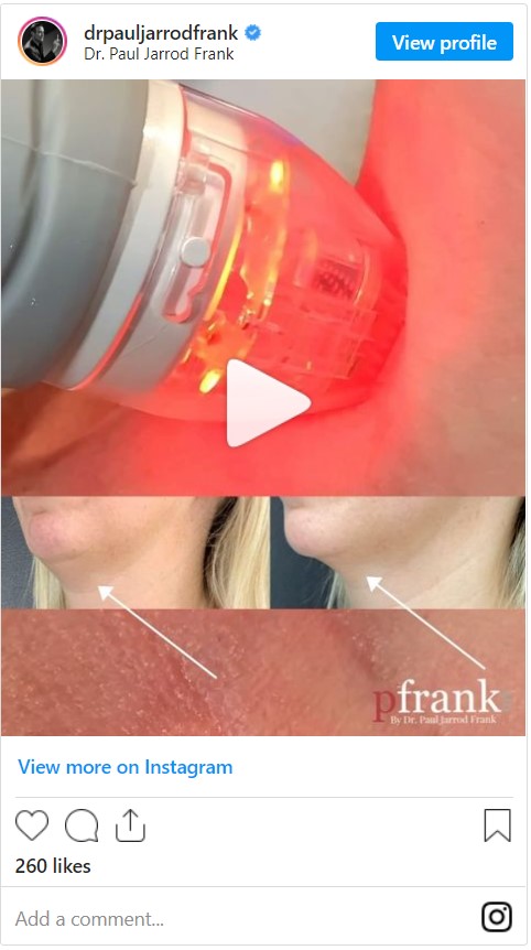 Vivace Microneedling RF treatment video by Dr. Paul Jarrod Frank of PFRANKMD in New York City, NY