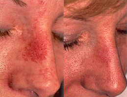Capillaries Before and After Photo by Dr. Frank in New York, NY