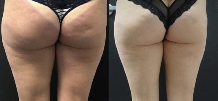 Cellulite Solution Before and After Photo by Dr. Frank in New York, NY