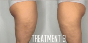 Cellulite Solution Before and After Photo by Dr. Frank in New York, NY