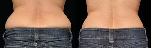 CoolSculpting Before and After Photo by Dr. Frank in New York, NY