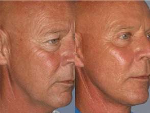 Coolpeel Before and After Photo by Dr. Frank in New York, NY