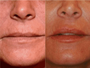 Coolpeel Before and After Photo by Dr. Frank in New York, NY