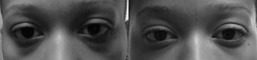 Dark Eye Circles Before and After Photo by Dr. Frank in New York, NY