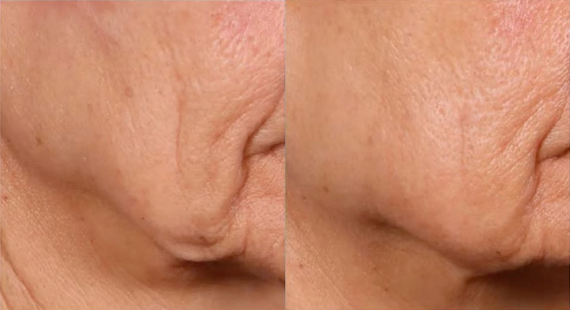 Ellacor Before and After Photo by Dr. Frank in New York, NY