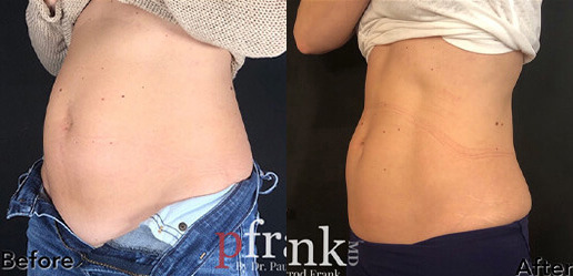 Emsculpt Before and After Photo by Dr. Frank in New York, NY