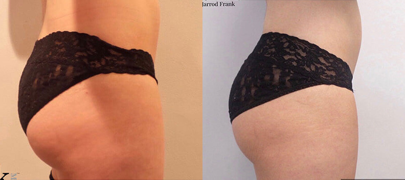 Emsculpt Before and After Photo by Dr. Frank in New York, NY