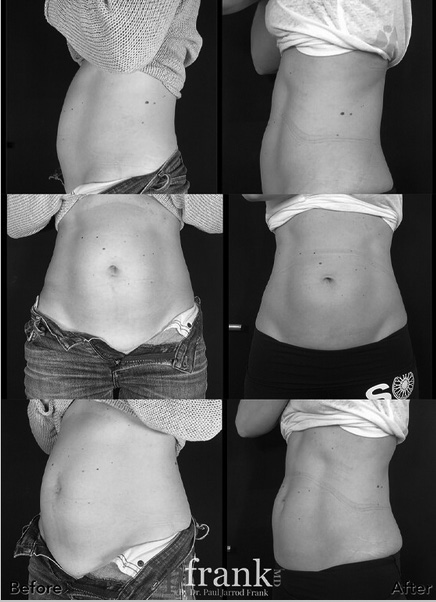 EmSculpt Before and After photo by Dr. Paul Jarrod Frank of PFRANKMD in New York City, NY