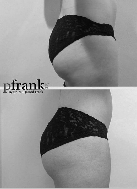 EmSculpt Before and After photo by Dr. Paul Jarrod Frank of PFRANKMD in New York City, NY
