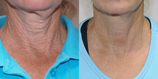 Exilis Ultra Before and After Photo by Dr. Frank in New York, NY