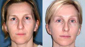 ThreadLift Before and After Photo by Dr. Frank in New York, NY