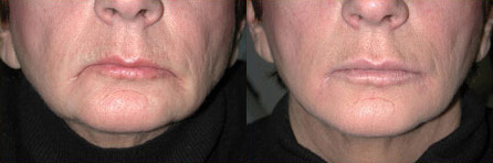 Filling Substances Before and After Photo by Dr. Frank in New York, NY