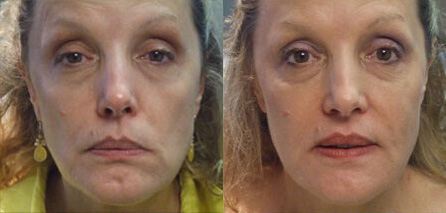FLT Non-Surgical Facelift Procedure Before and After Photo by Dr. Frank in New York, NY