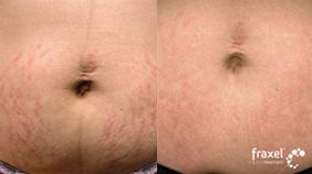 Fraxel Restore/Repair Before and After Photo by Dr. Frank in New York, NY