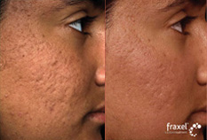 Fraxel Restore/Repair Before and After Photo by Dr. Frank in New York, NY