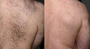 Laser Hair Removal Before and After Photo by Dr. Frank in New York, NY