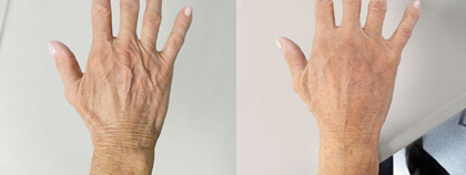Hand Rejuvenation Before and After Photo by Dr. Frank in New York, NY