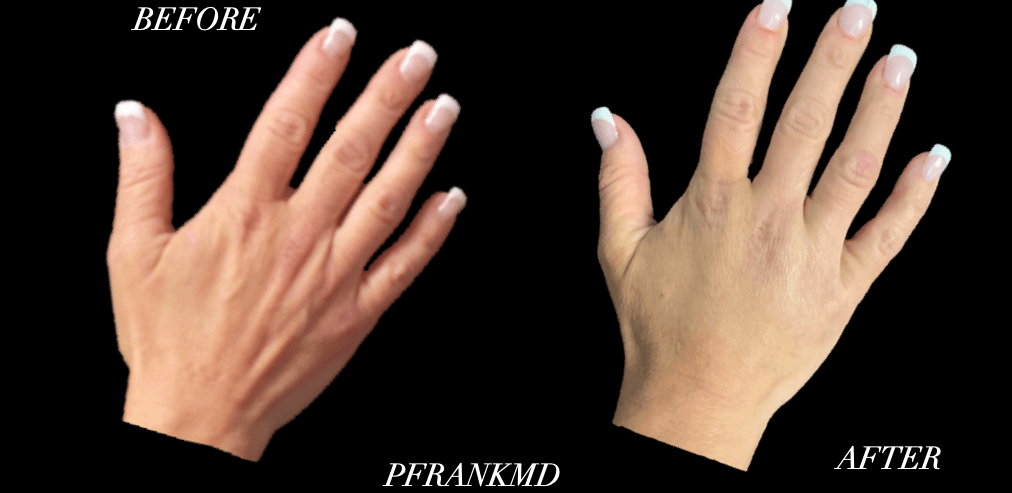 Hand Rejuvenation Before and After Photo by Dr. Frank in New York, NY