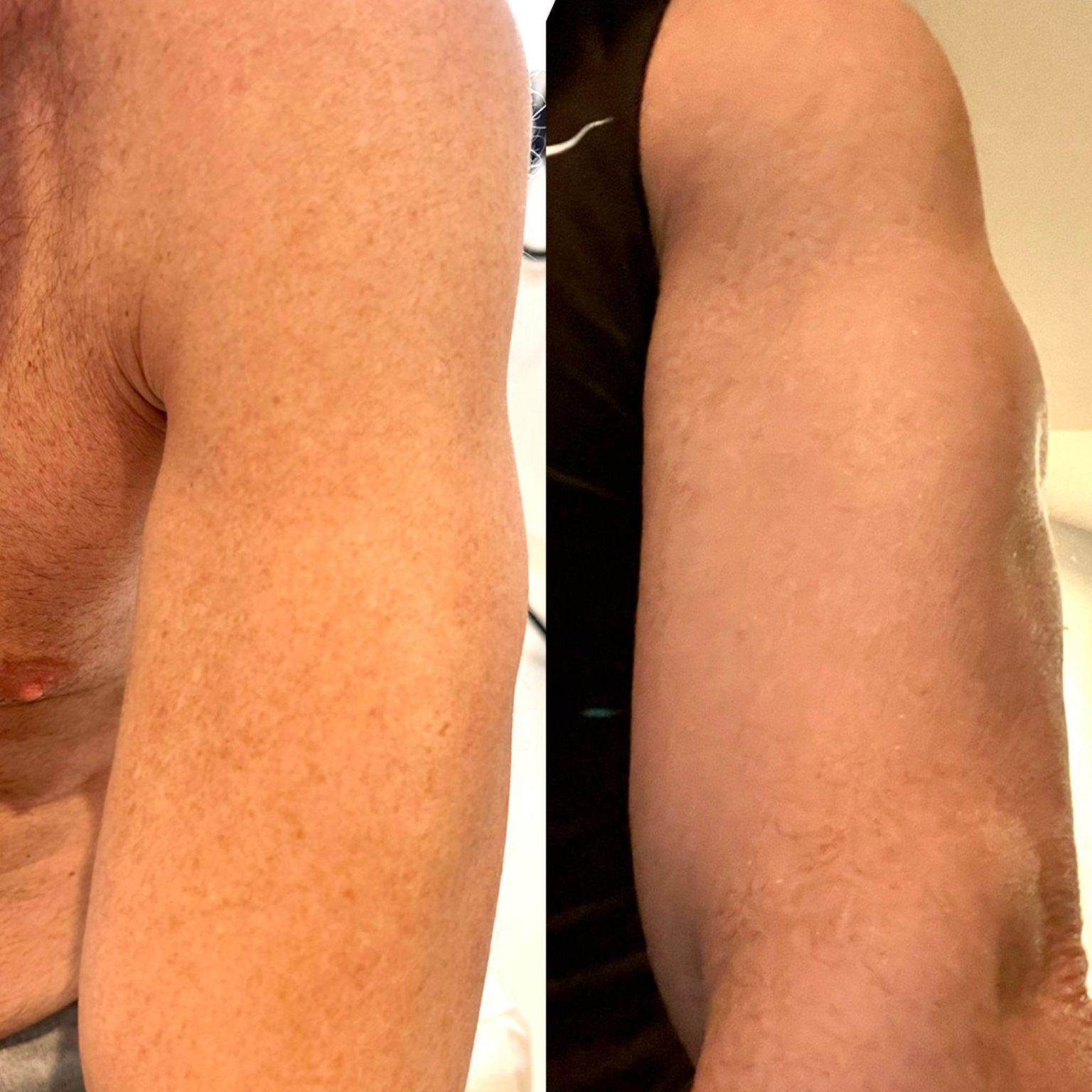 BBL arms treatment Before and After photo by Dr. Paul Jarrod Frank of PFRANKMD in New York City, NY